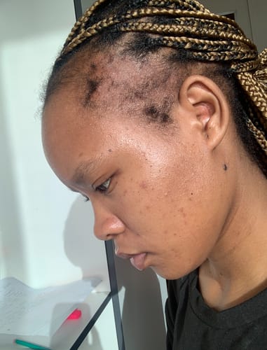 Customer photo review of Minoxidil High Strength (5%) SOLUTION, 3x60ml pack