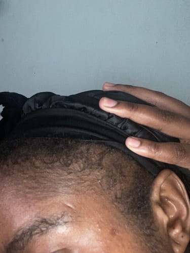 Customer photo review of Minoxidil 5% Solution, 1 Pack 60ml