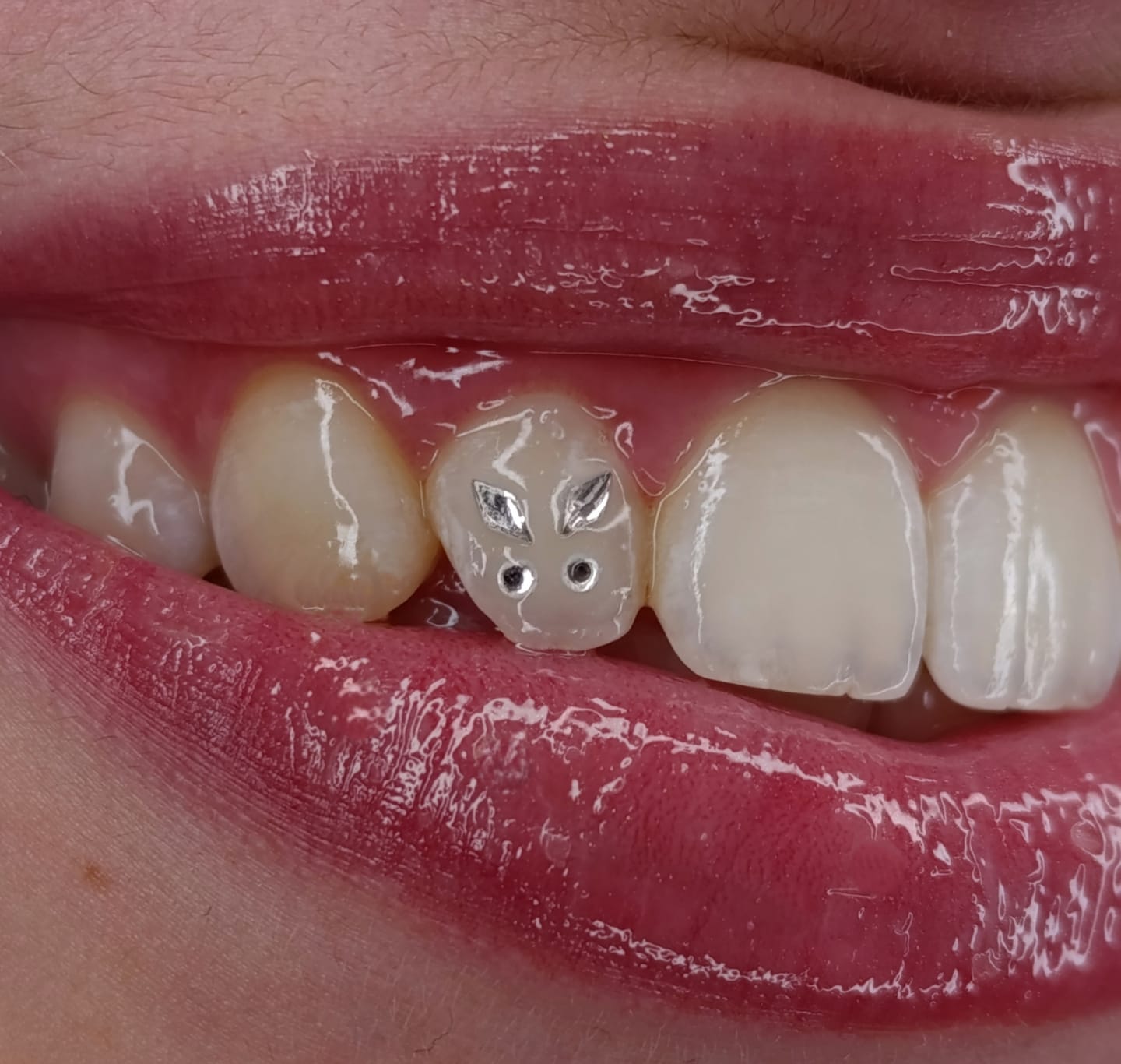 Customer photo review of Pack de adhesivos dentales