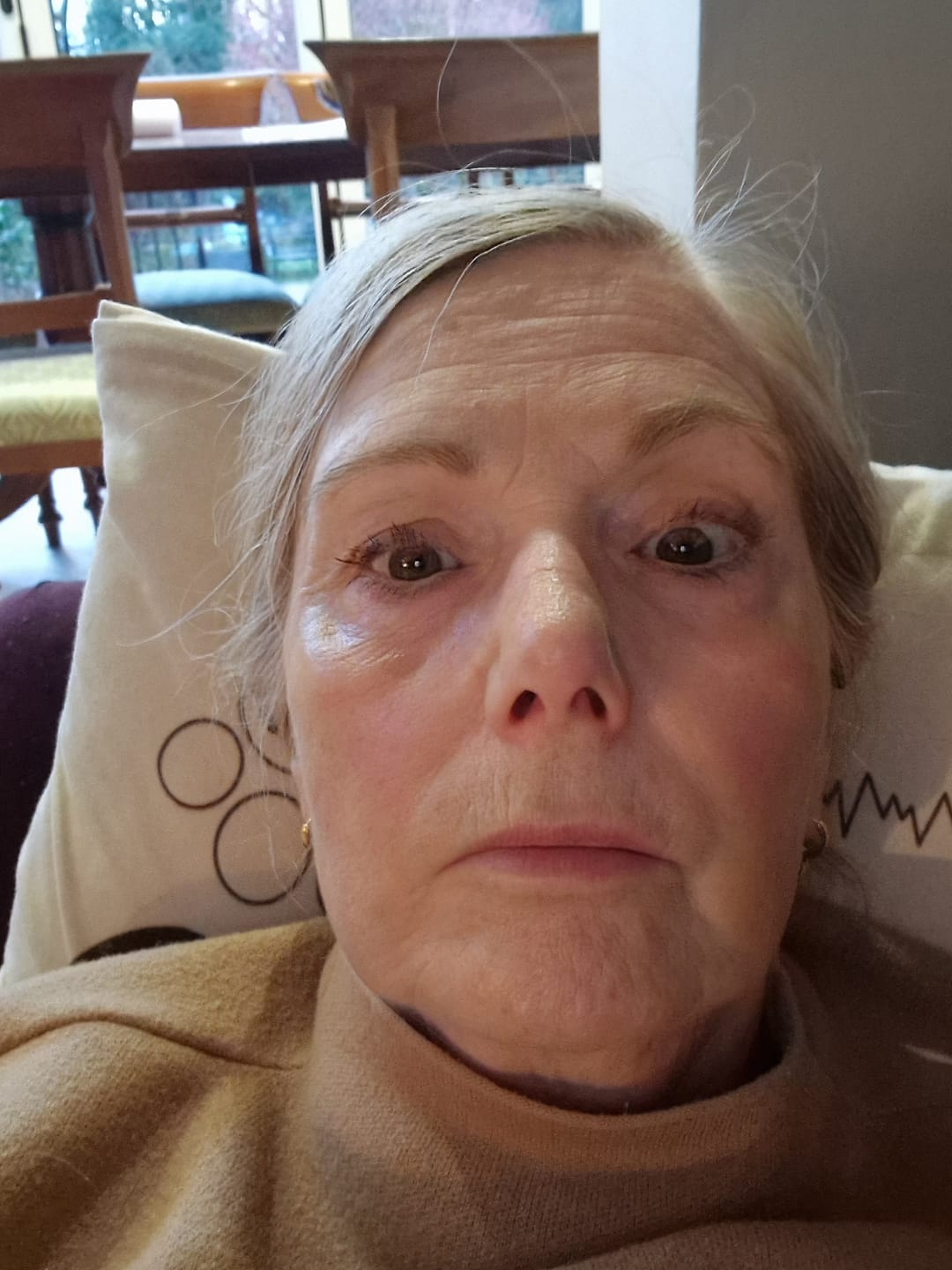 Customer photo review of Rosalique 3 in 1 Anti-Redness Miracle Formula SPF50