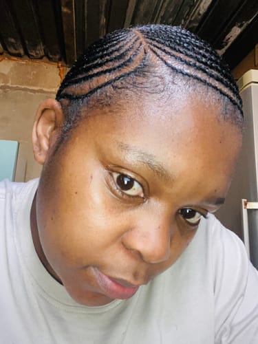 Customer photo review of Minoxidil 5% Solution, 1 Pack 60ml