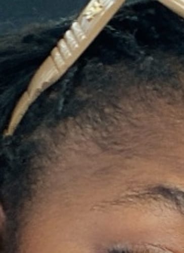 Customer photo review of Minoxidil 5% Solution, 1 Pack 60ml