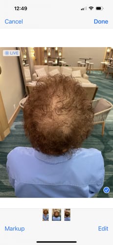 Reviewer's hair from behind, showing significant thinning at the crown before using the Glov Micro Infusion System.