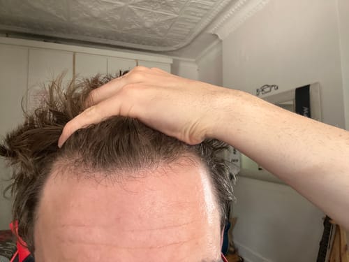 Customer photo review of Minoxidil High Strength (5%) SOLUTION, 3x60ml pack