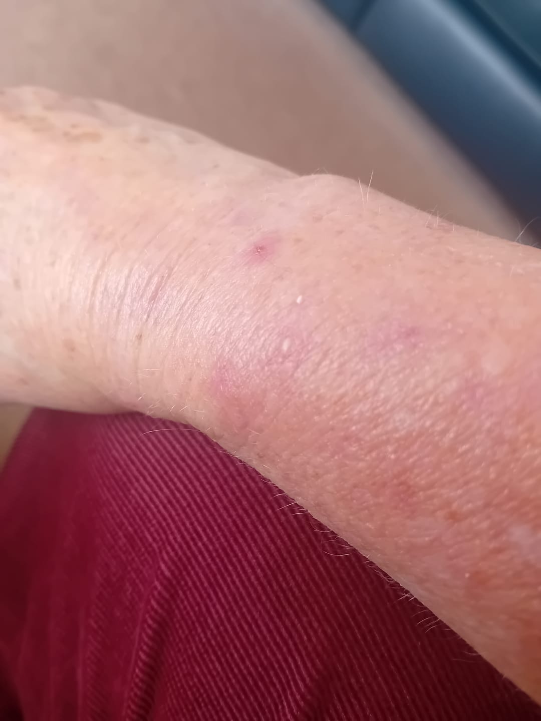 Customer photo review of Bioskin Zeoderm Skin Repair Moisturiser