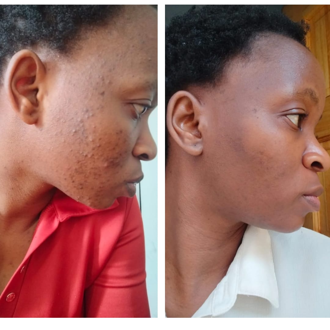 Customer photo review of Gmaeum Acne Essentials Set