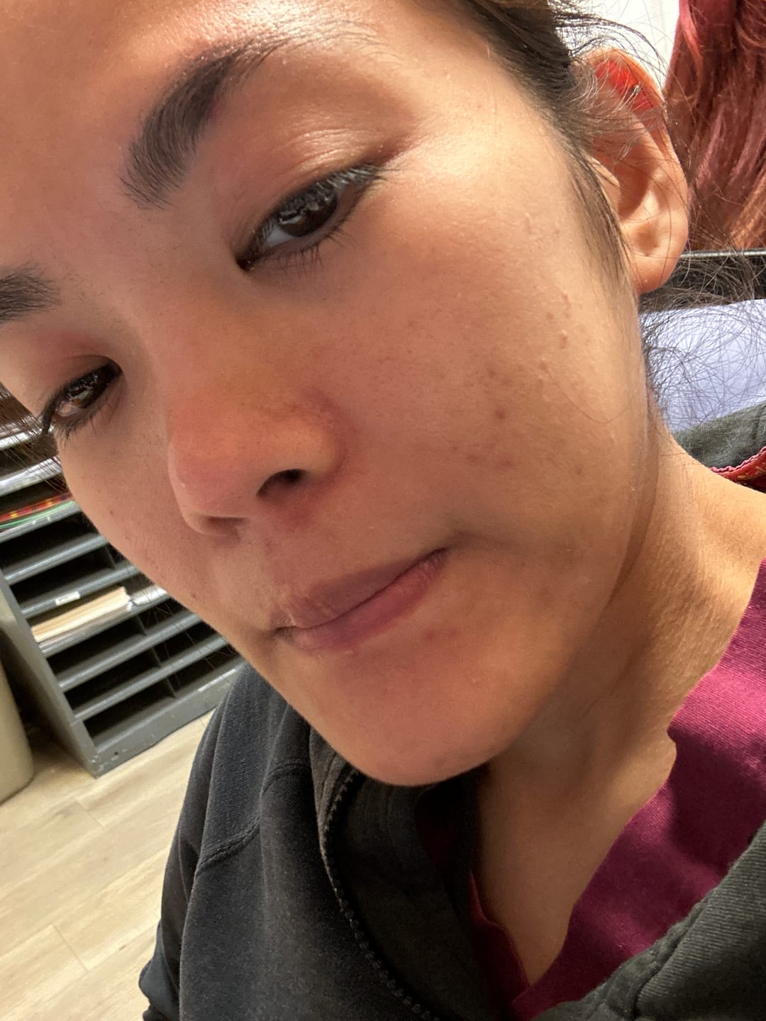 Customer photo review of Acne Drying Lotion Plus — 2 Pack (20 mL × 2)