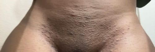 Close-up of a reviewer's bikini area showing razor bumps and irritation before using the Bright & Even Skin Kit.