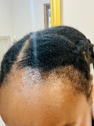 Customer photo review of Minoxidil 5% Solution, 1 Pack 60ml