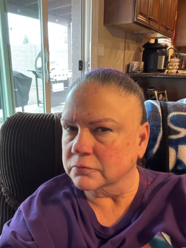 Reviewer's close-up shows their facial skin after using the Seranova Micro Infusion System to smooth lines.