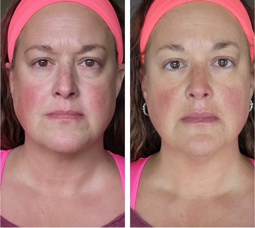 Customer photo review of EvenSkyn® Lumo⁺: Premium Anti-Aging & Skin Tightening Handset (2025)