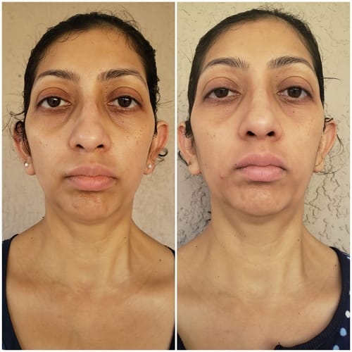 Customer photo review of EvenSkyn® Lumo⁺: Premium Anti-Aging & Skin Tightening Handset (2025)