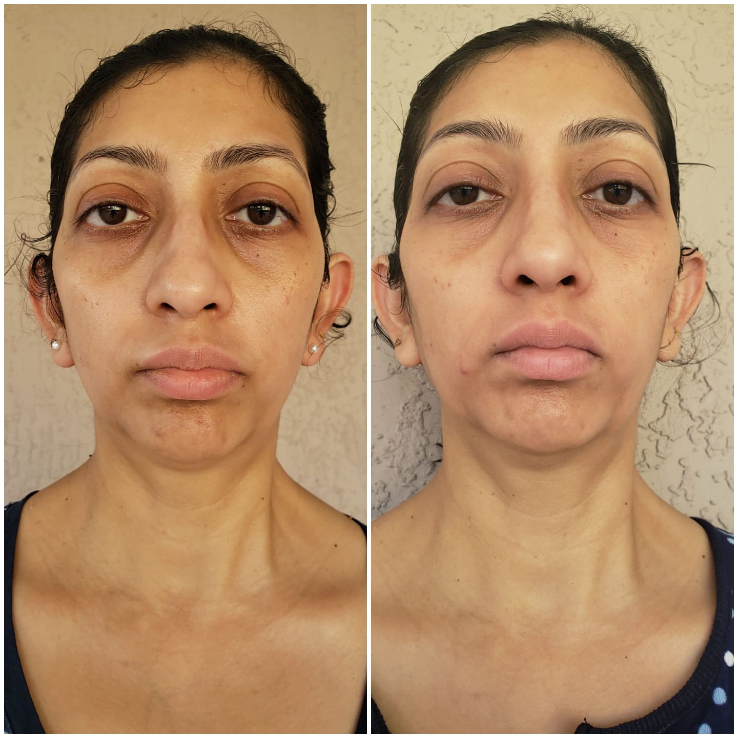 Customer photo review of EvenSkyn® Lumo⁺: Premium Anti-Aging & Skin Tightening Handset (2025)