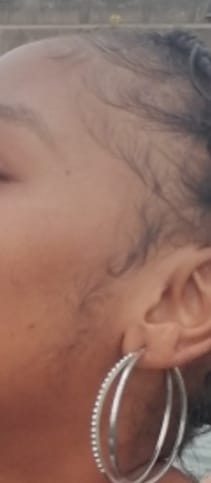 Customer photo review of Minoxidil High Strength (5%) SOLUTION, 3x60ml pack