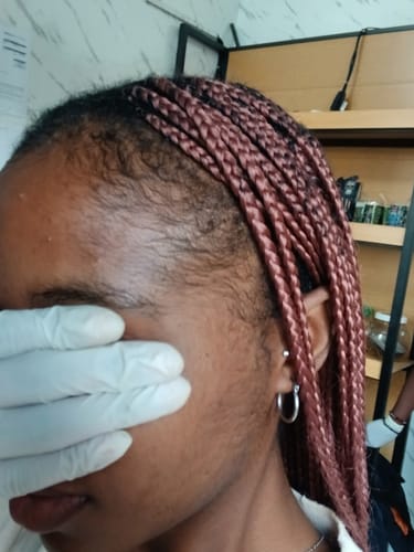 Customer photo review of Minoxidil High Strength (5%) SOLUTION, 3x60ml pack