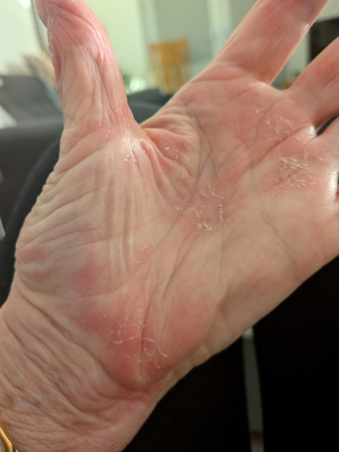 Customer photo review of Bioskin Zeoderm Skin Repair Moisturiser