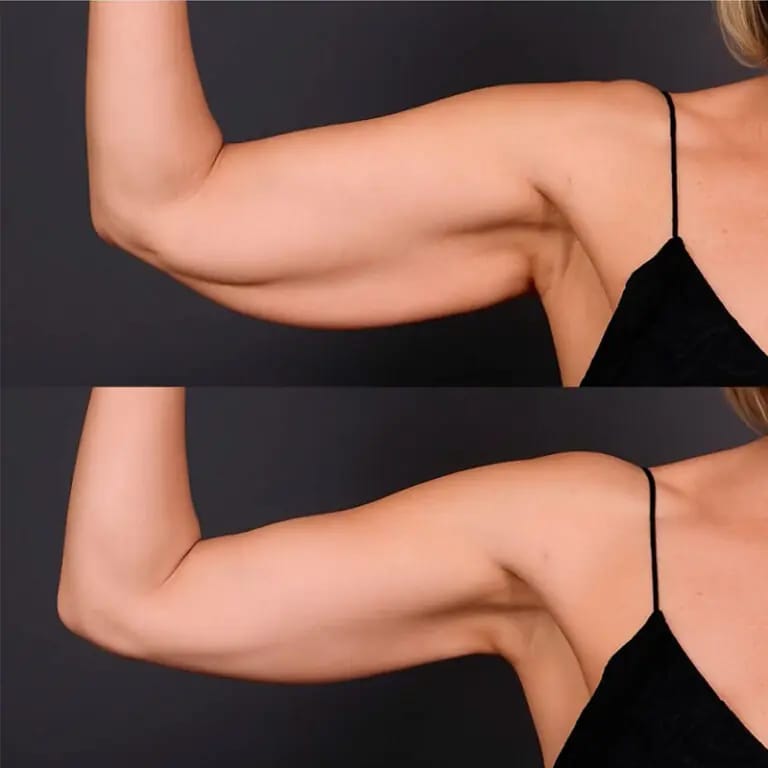Customer photo review of BodySculpt 1.0™
