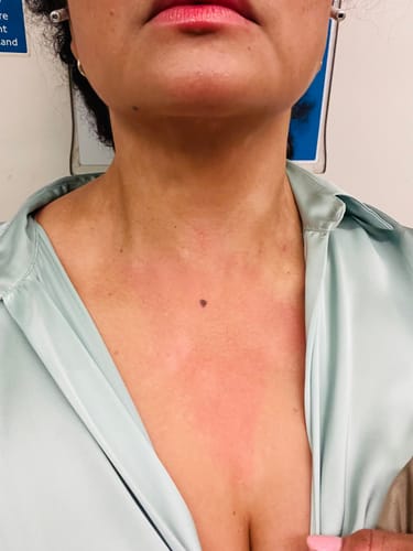 Customer showing red, inflamed skin on their neck and chest area before using Calm Balm.