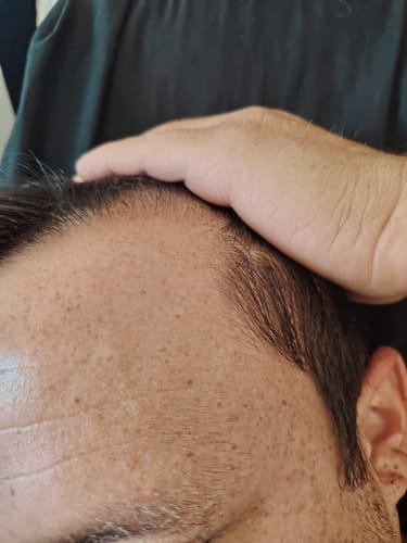 Customer photo review of Minoxidil DOUBLE ACTION FOAM, MEN ONLY 3x60ml Pack