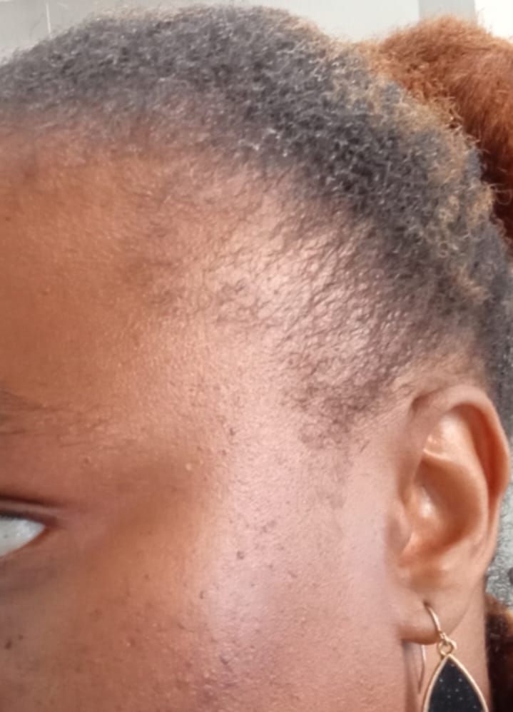 Customer photo review of Scalp Serum Set - Minoxidil