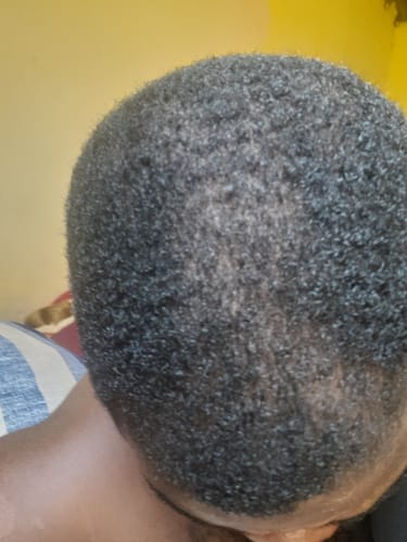 Customer photo review of Minoxidil High Strength (5%) SOLUTION, 3x60ml pack