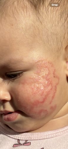 Customer photo of a baby's cheek showing severe, red eczema before using Calm Balm.