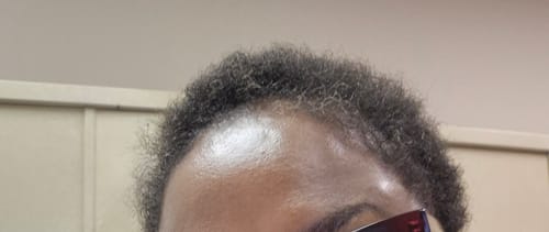 Customer photo review of Minoxidil High Strength (5%) SOLUTION, 3x60ml pack