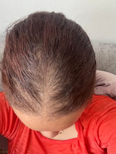 Customer photo review of Minoxidil High Strength (5%) SOLUTION, 3x60ml pack