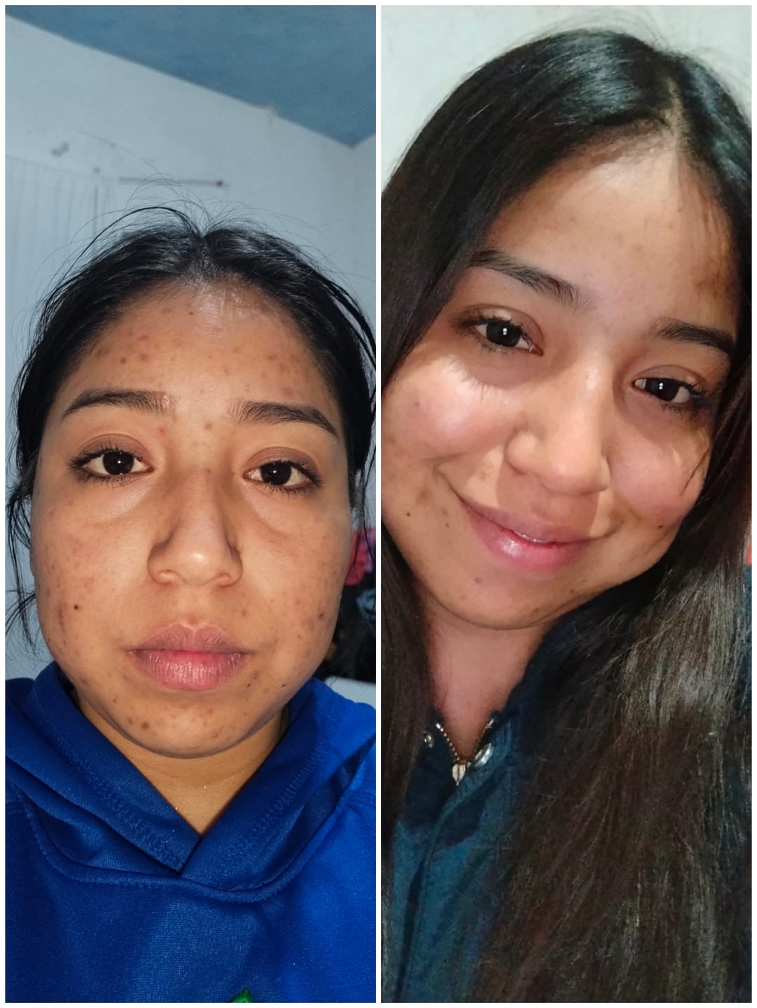 Customer photo review of Mascarilla de Arcilla con 3 Ácidos para Limpieza Profunda de Poros