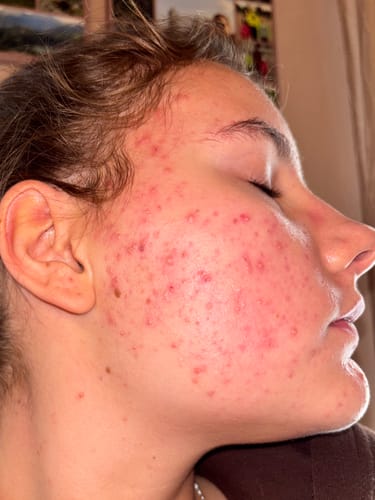 Customer photo review of Teint Précieux – Dermo-Reinigungsseife gegen Akne