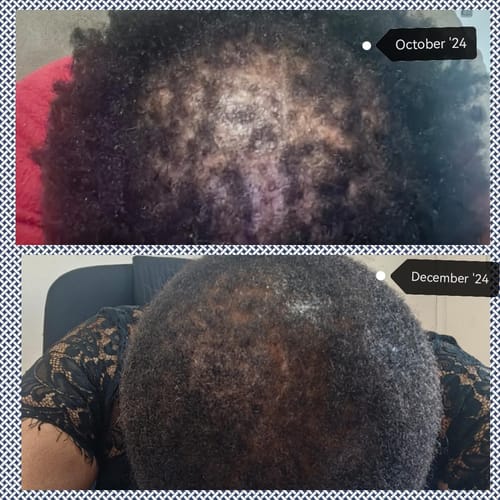 Customer photo review of Minoxidil High Strength (5%) SOLUTION, 3x60ml pack