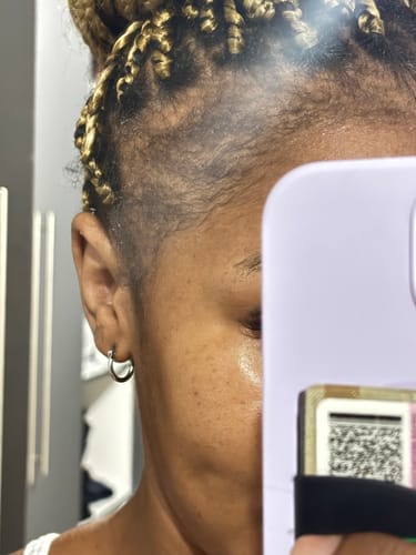 Customer photo review of Minoxidil 5% Solution, 1 Pack 60ml