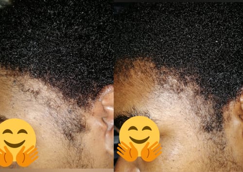 Customer photo review of Minoxidil 5% Solution, 1 Pack 60ml