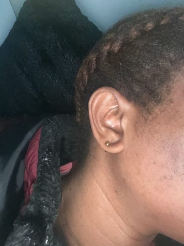 Customer photo review of Anti-Acne & Dark Spots Bar