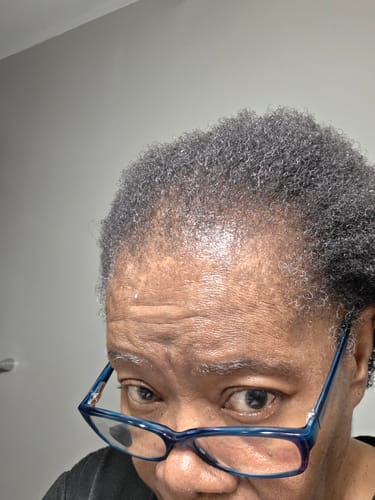 Close-up of the reviewer's thinning hairline before using the Hair Elixir Oil.