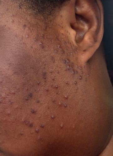 Customer photo review of Anti-Acne & Dark Spots Bar