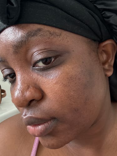 Customer photo review of Anti-Acne & Dark Spots Bar