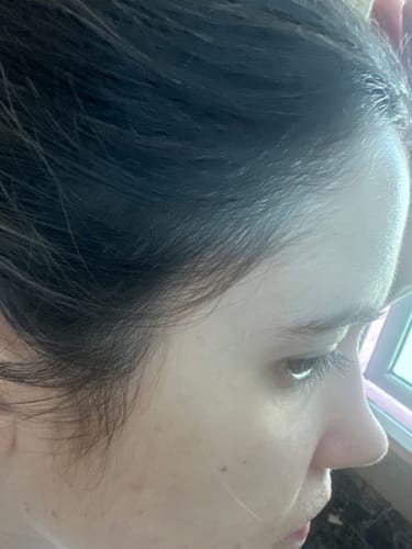 Customer photo review of Hair Loss Prevention Kit