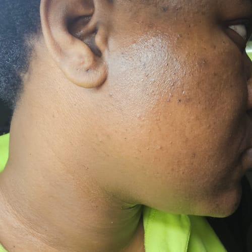 Customer photo review of Anti-Acne & Dark Spots Bar