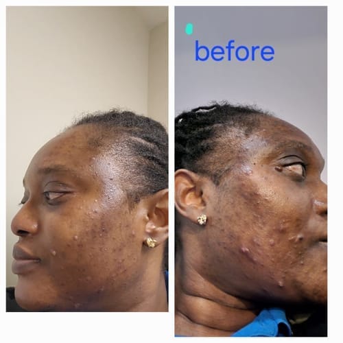 Customer photo review of Anti-Acne & Dark Spots Bar