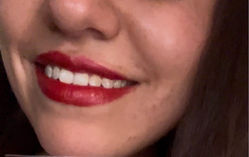 Customer photo review of Tiras Blanqueadoras VITTÉ Pack 14 días