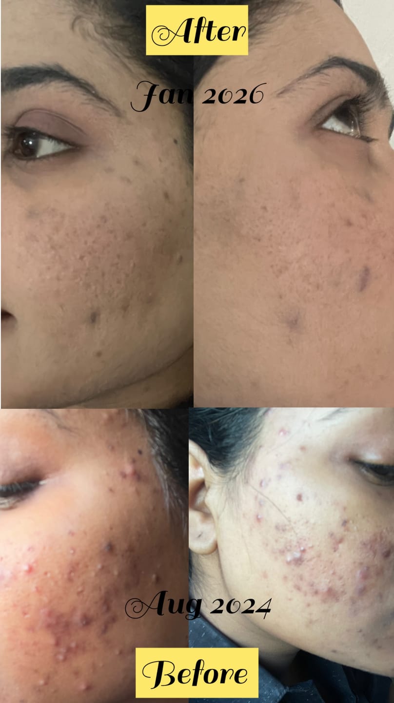 Customer photo review of Intense Pigmentation Bundle