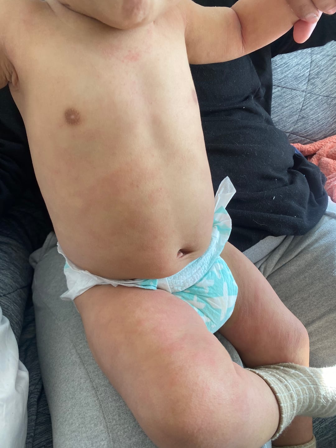Customer photo review of Kawakawa Balm - Winner, Best SOS/Healing Balm