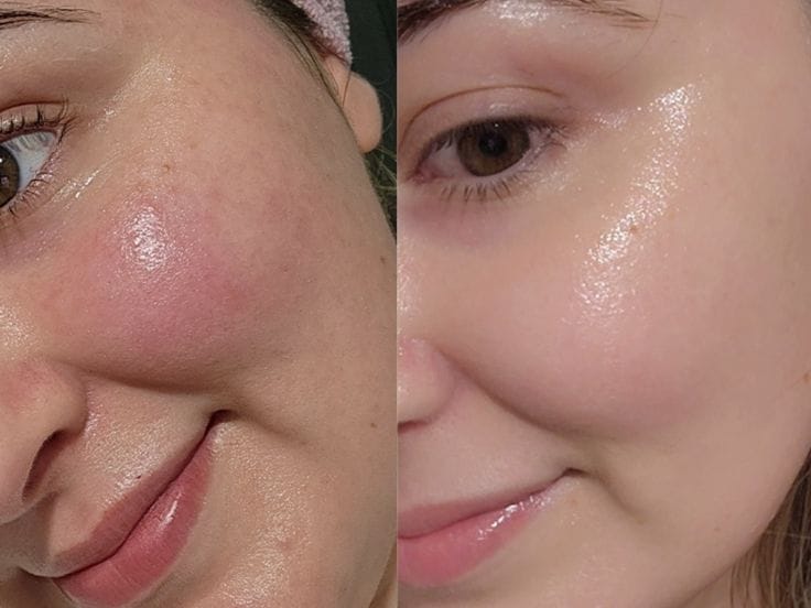 Customer photo review of Dermive Urea Economy Pack
