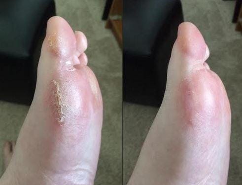 Customer photo review of FeetCARE PRO™ | Fjerner Hard Hud Raskt & Effektivt