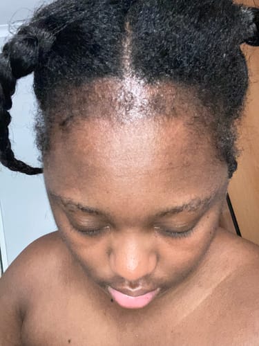 Customer photo review of Minoxidil High Strength (5%) SOLUTION, 3x60ml pack