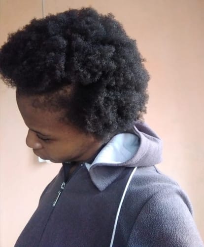 Customer photo review of Minoxidil High Strength (5%) SOLUTION, 3x60ml pack