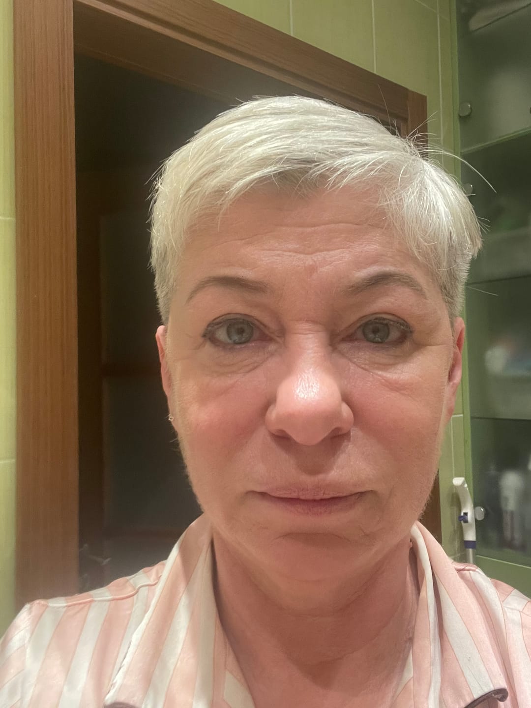 Customer photo review of Intensīvs serums-būsteris ar mikroadatām VT Cosmetics Reedle Shot 300