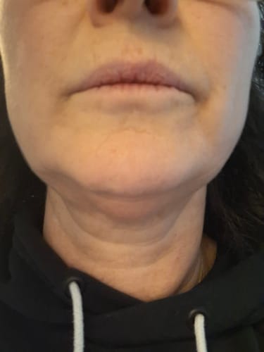 Customer photo review of COSTIQ® LONG LASTING LIP PLUMPER