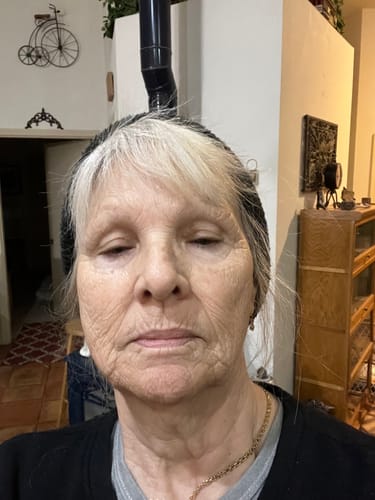 A reviewer's close-up photo showing facial wrinkles and skin texture during treatment with the Micro Infusion System.